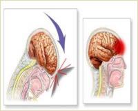 Damage to brain infographic